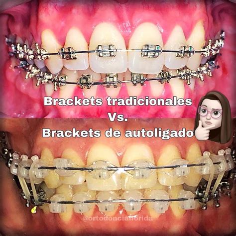 diferencias entre brackets metalicos y autoligables|brackets autoligables.